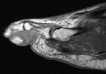 Figure 4 for case Nodular Localized Cutaneous Amyloidosis